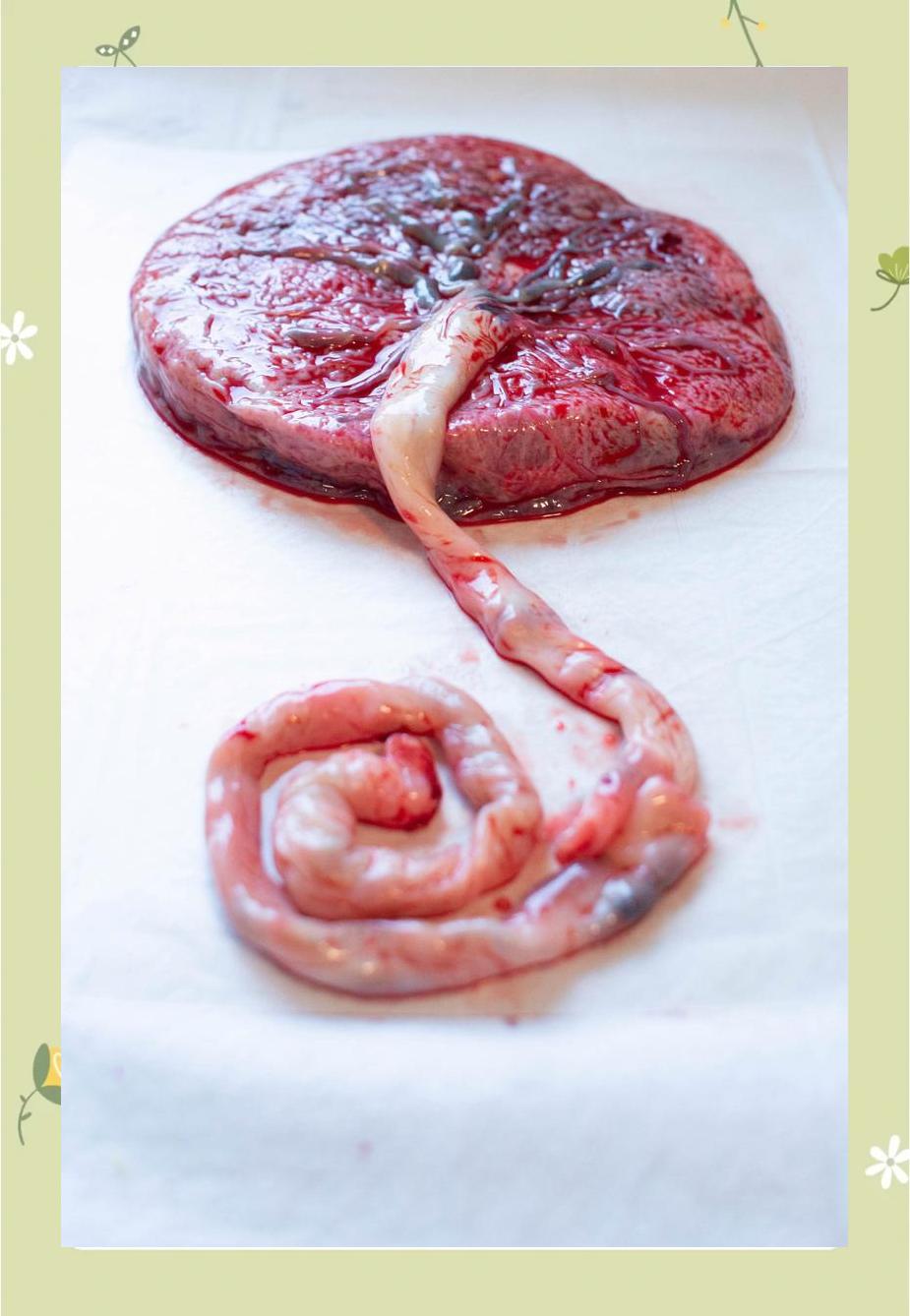 边缘性前置胎盘能顺产吗