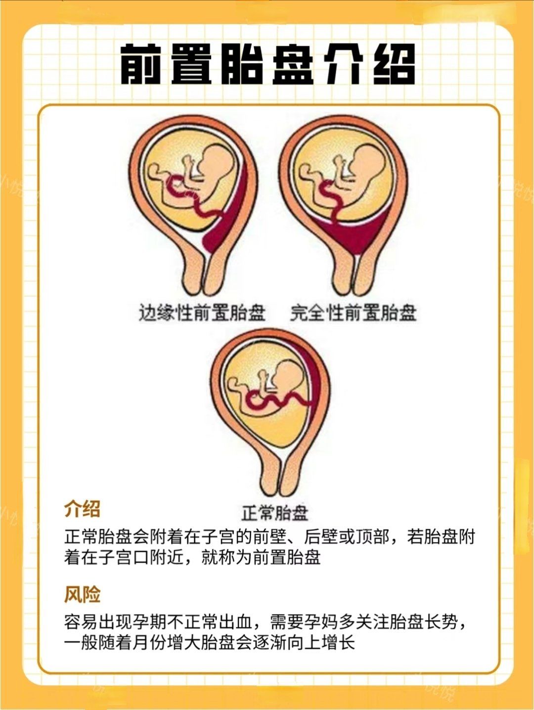 边缘性前置胎盘能顺产吗