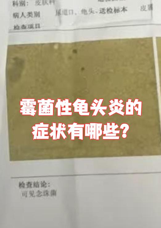 男性有霉菌感染的症状