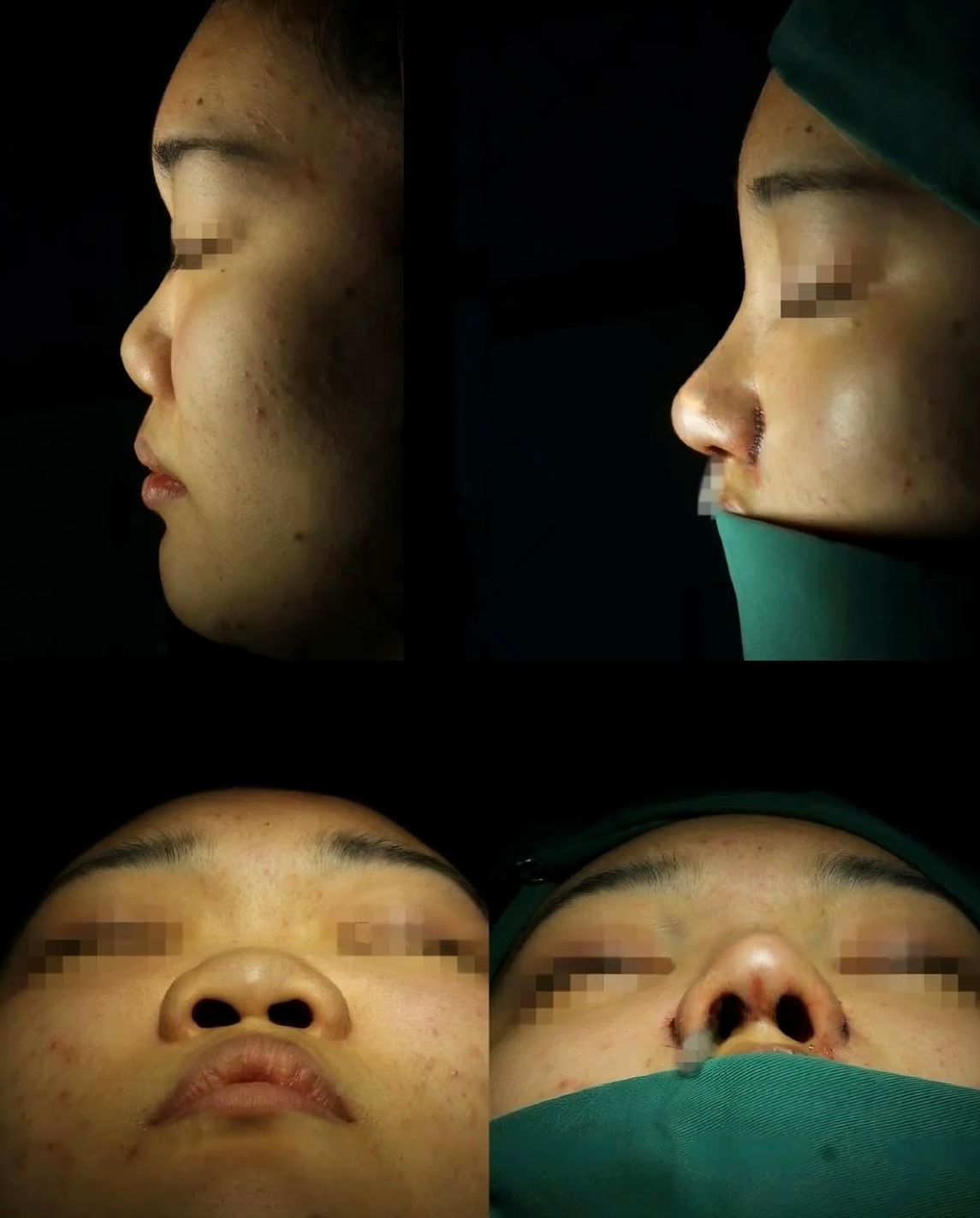 鼻梁特别塌,几乎没有怎么办?整容除外..