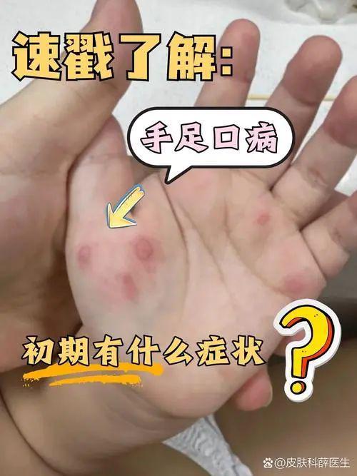 手口足病是什么?