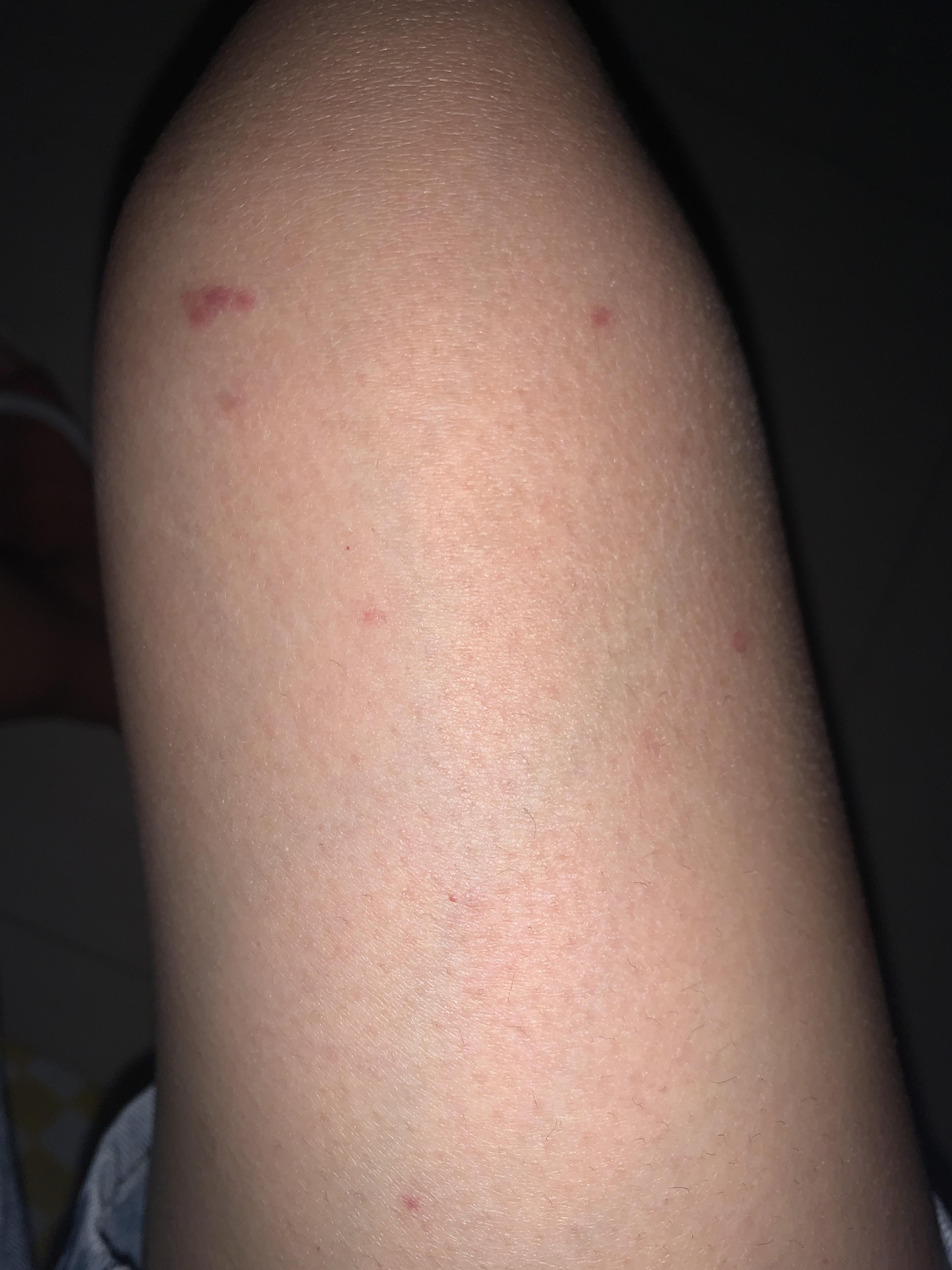 身上长红点不痛不痒