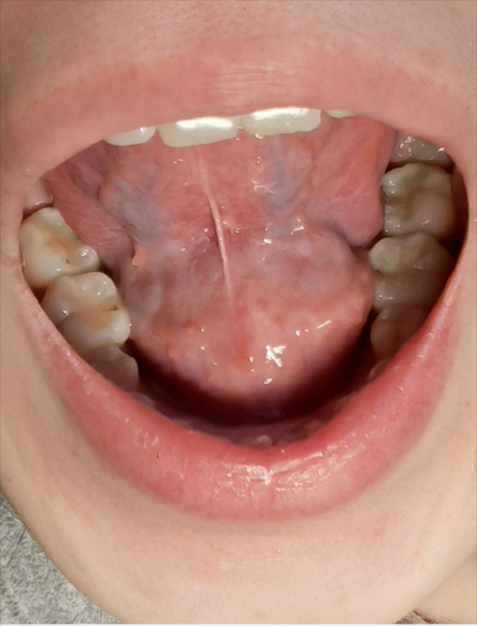 舌下腺囊肿的超声表现