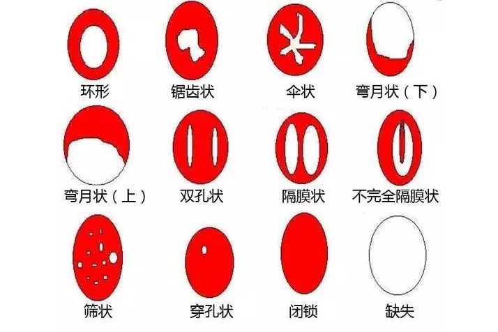 处女膜能用肉眼看到么?什么样?