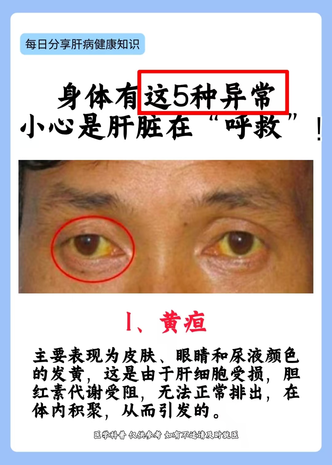 肝胆湿热症状有哪些