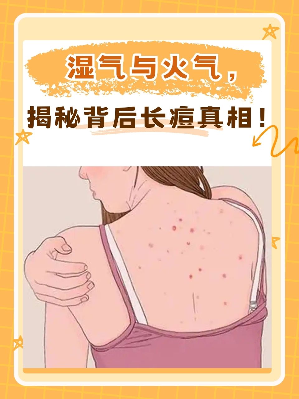 背后长痘痘是什么原因?
