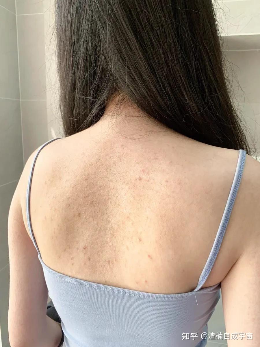 背后长痘痘是什么原因?