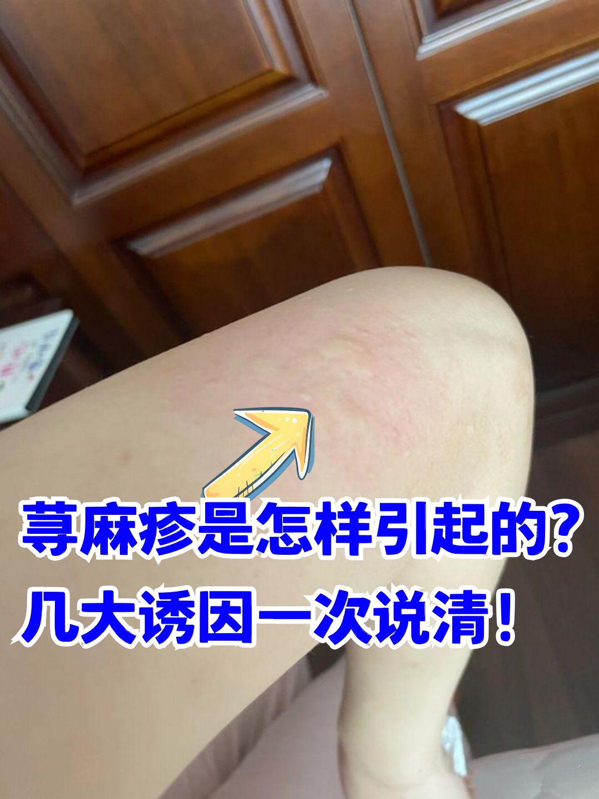 为什么荨麻疹晚上总发作???