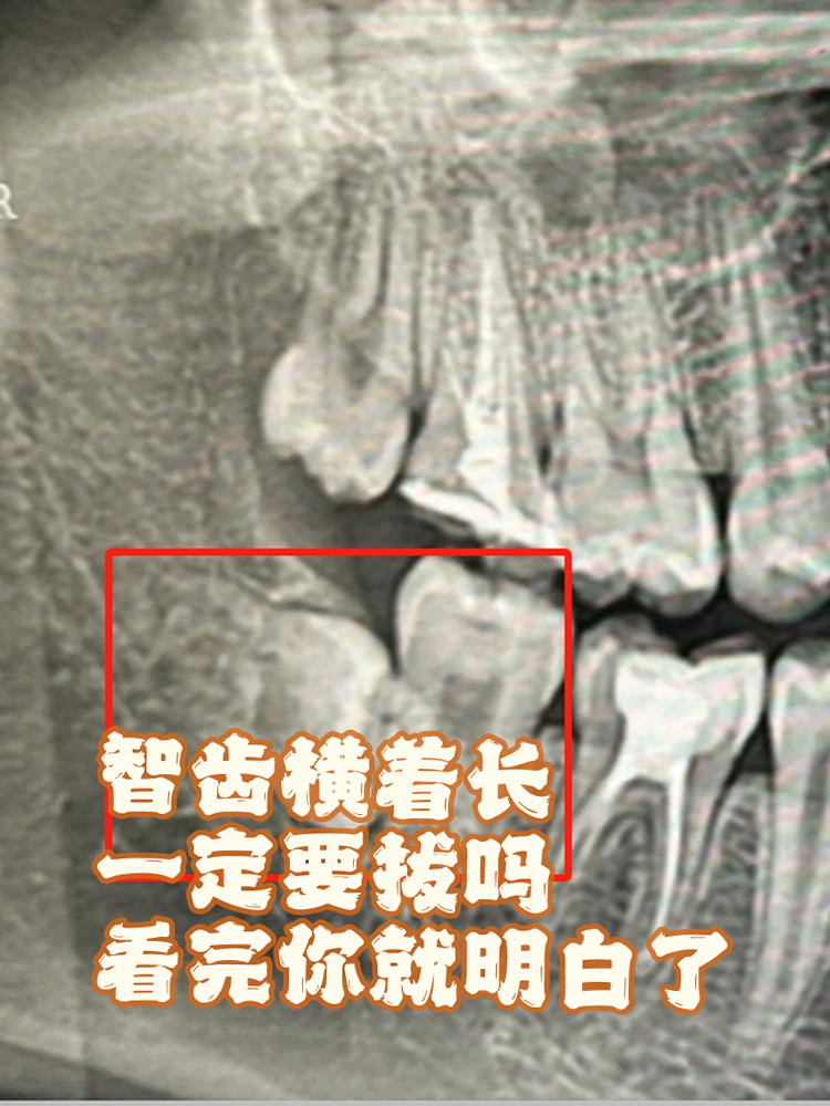拔智齿可以不拍片吗?