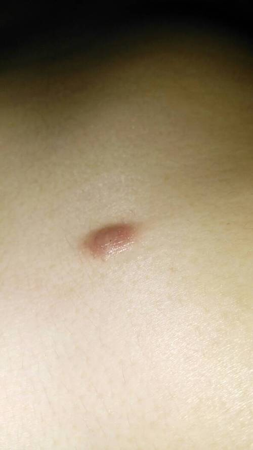 痘痘挤了后红肿,是硬块怎么办