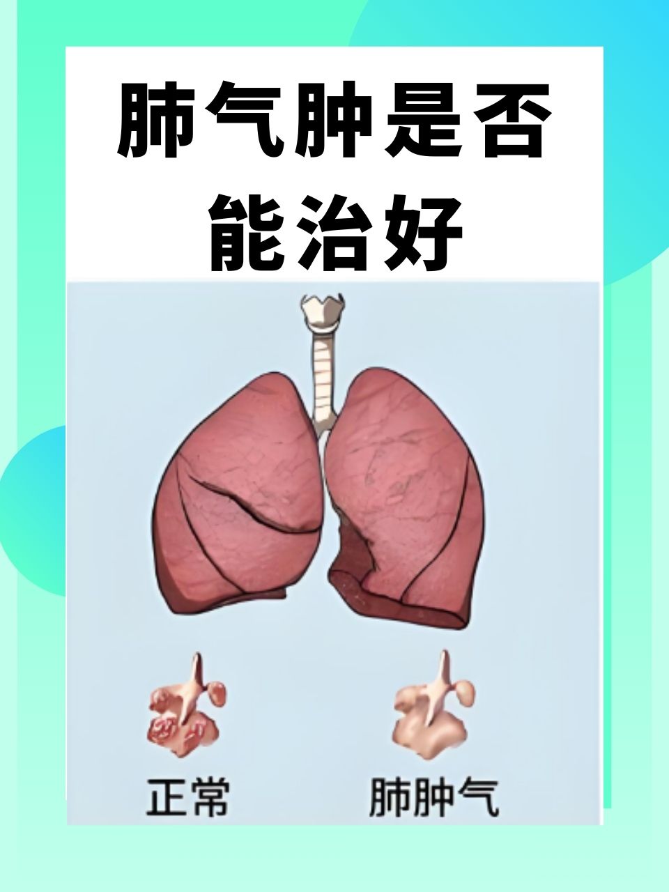 肺气肿能治疗好吗?