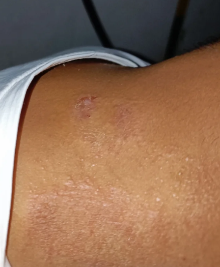 体癣是什么原因引起的