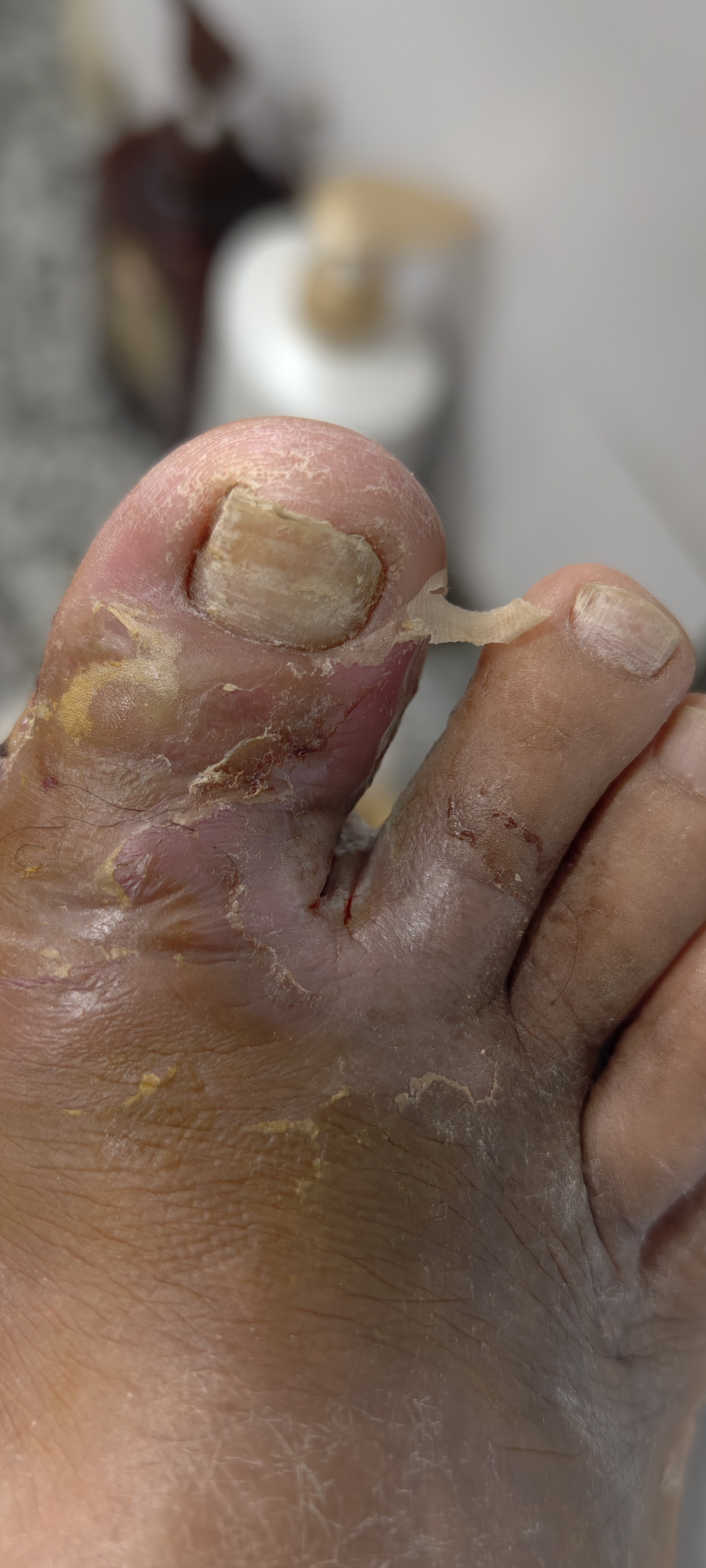 糖尿病足的症状