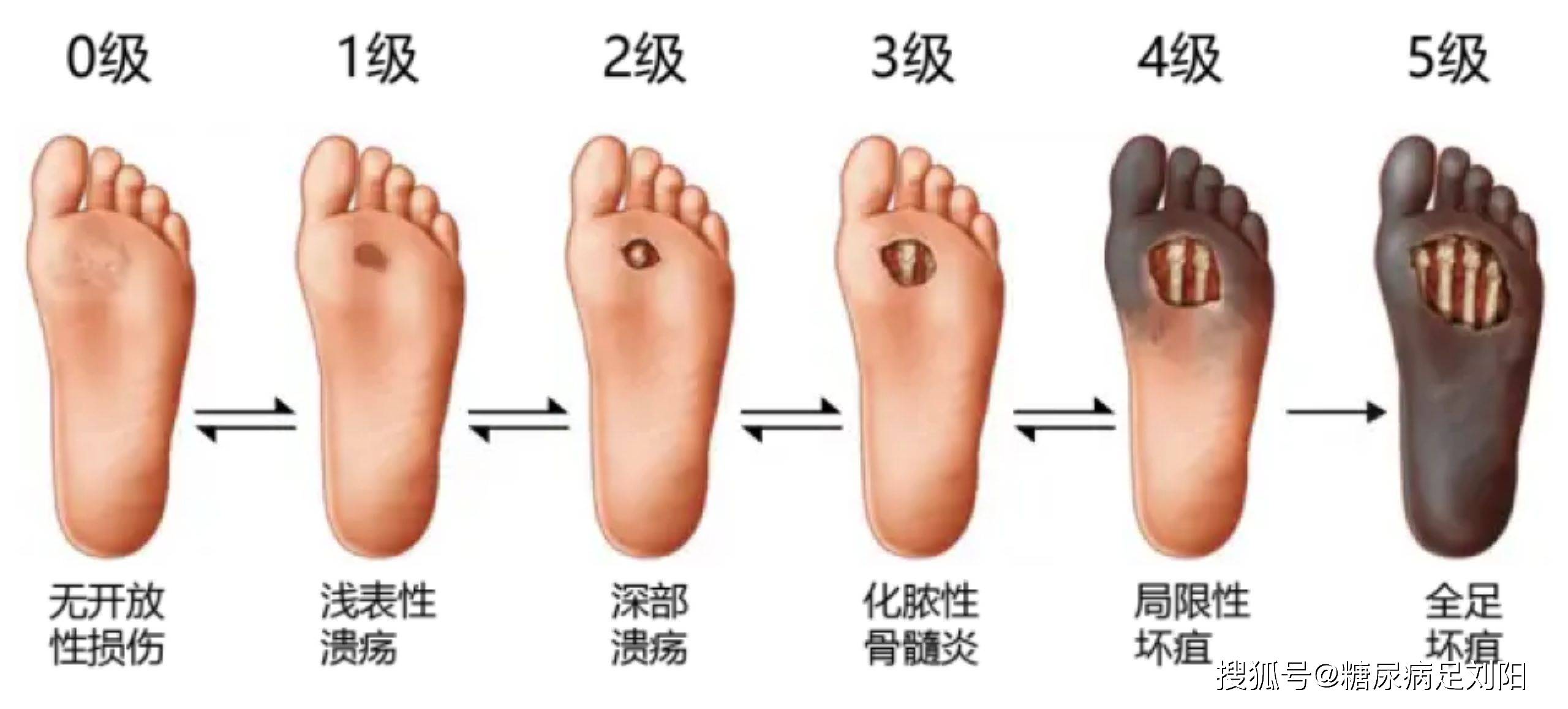 糖尿病足的症状
