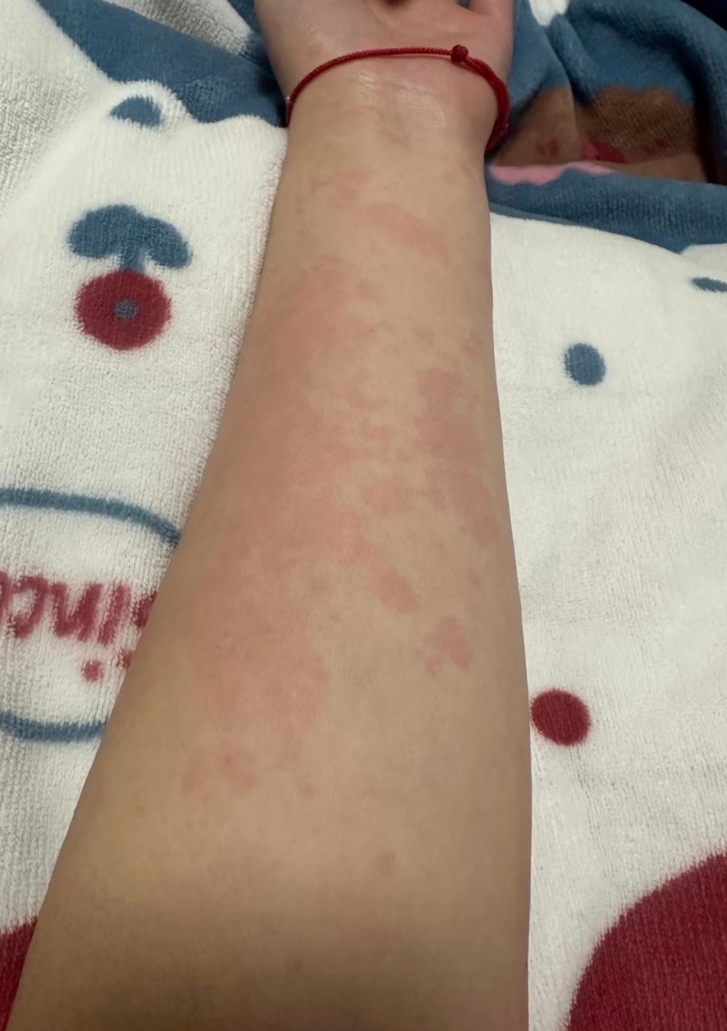 过敏性荨麻疹多久会好?