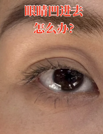 眼睛凹陷是怎么回事