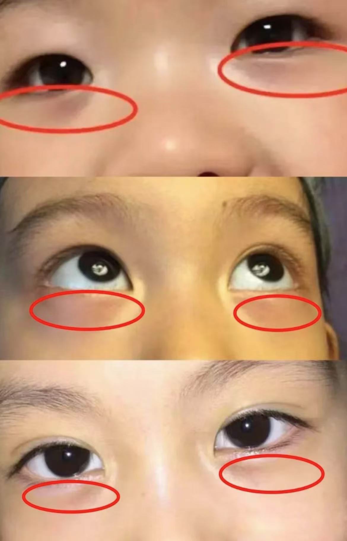 眼睛凹陷是怎么回事