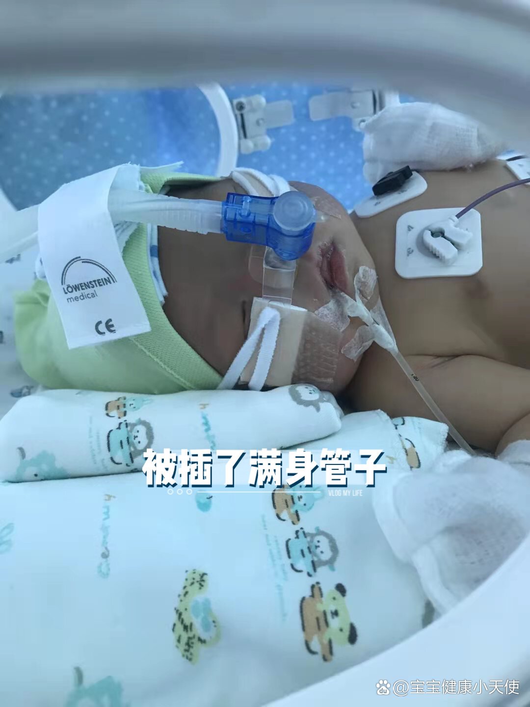 什么是新生儿窒息