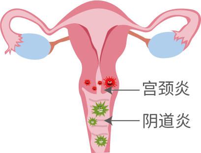 外阴道炎怎么办