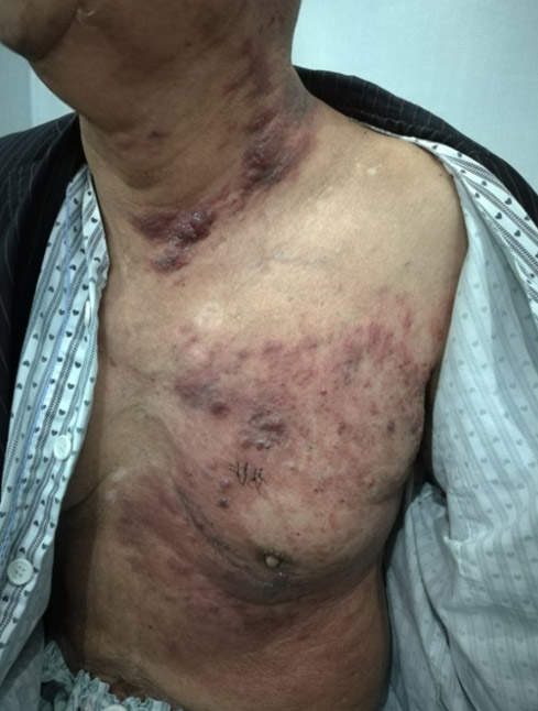 男性乳腺癌的早期症状