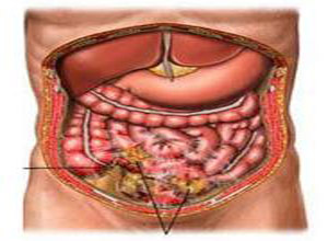 急性腹膜炎的体征