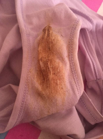 图片中这个是褐色白带吗为什么会出现这样