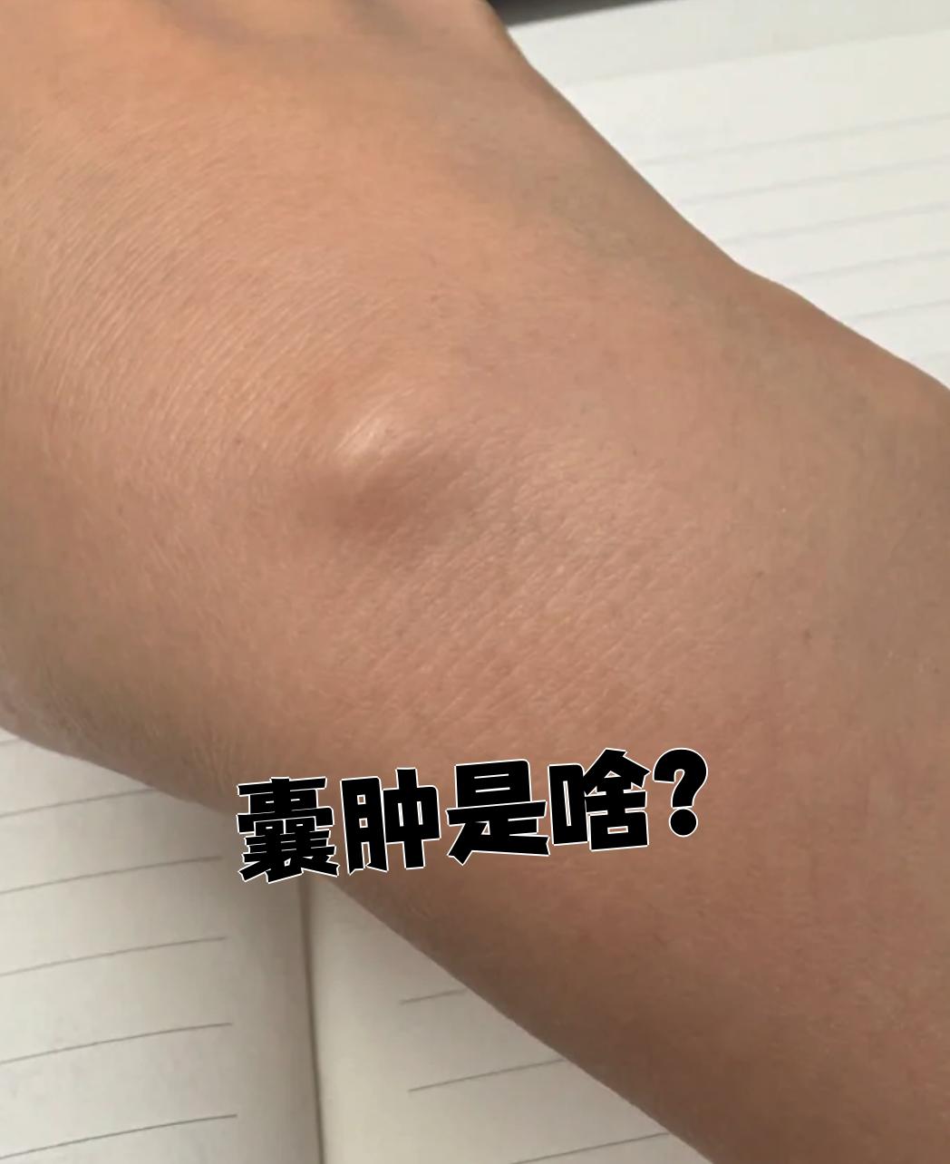 表皮囊肿是什么原因引起的?