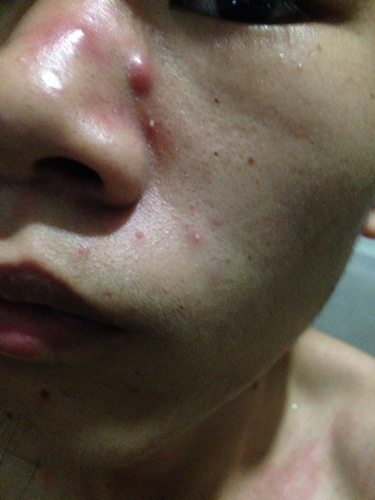 鼻子左侧肿了。一按就疼。