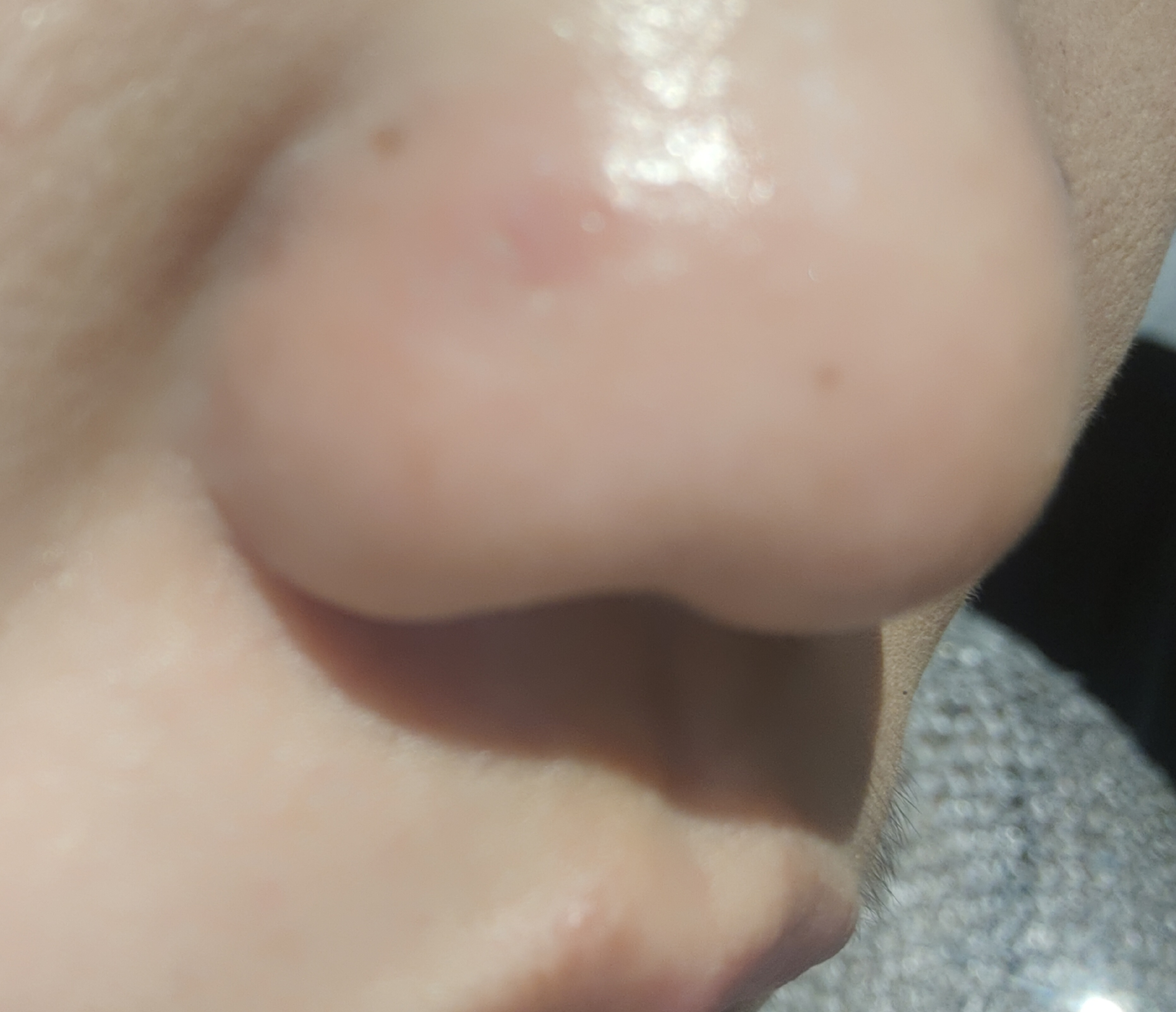 鼻子左侧肿了。一按就疼。