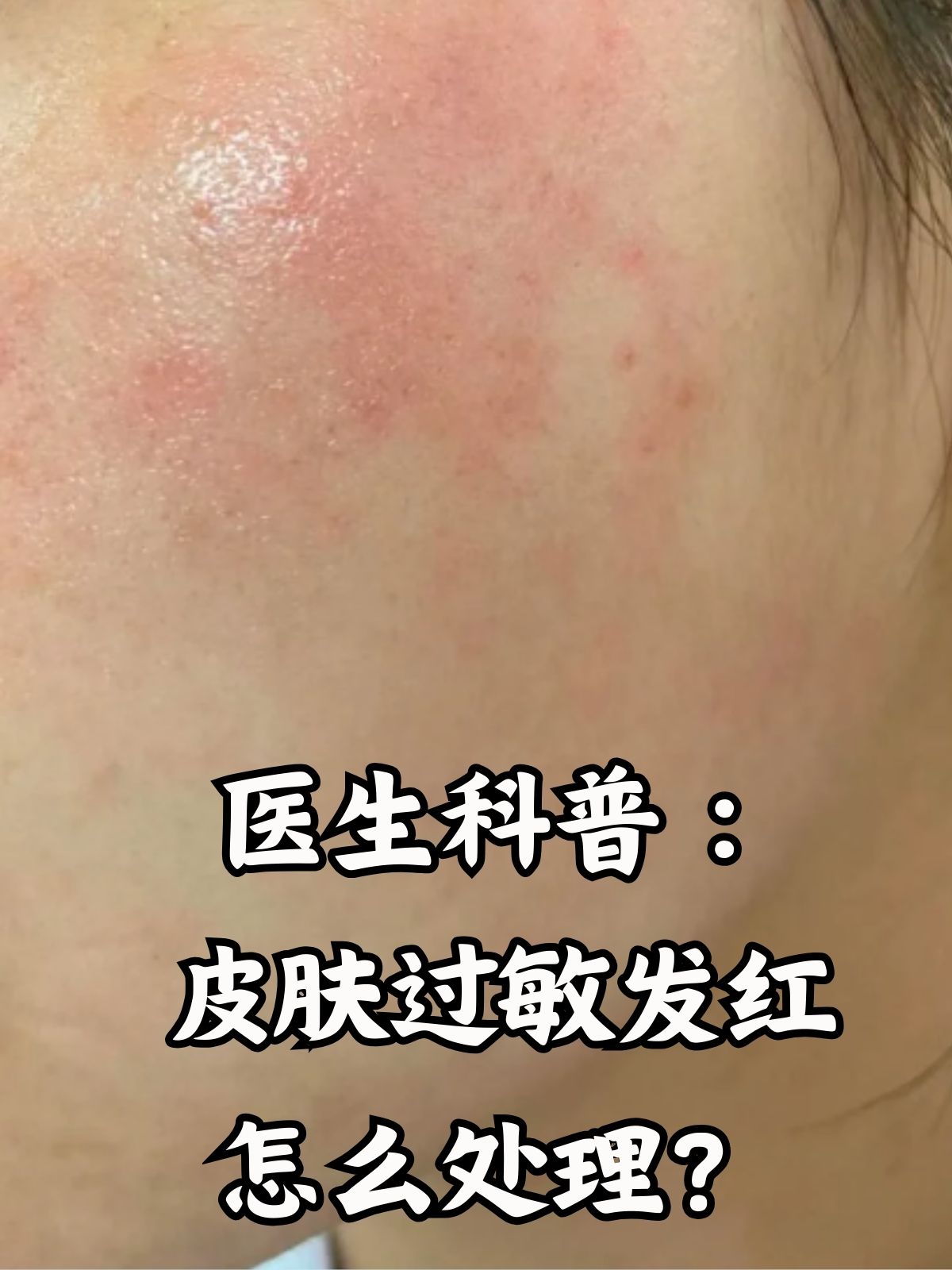 脸过敏发红痒怎么办