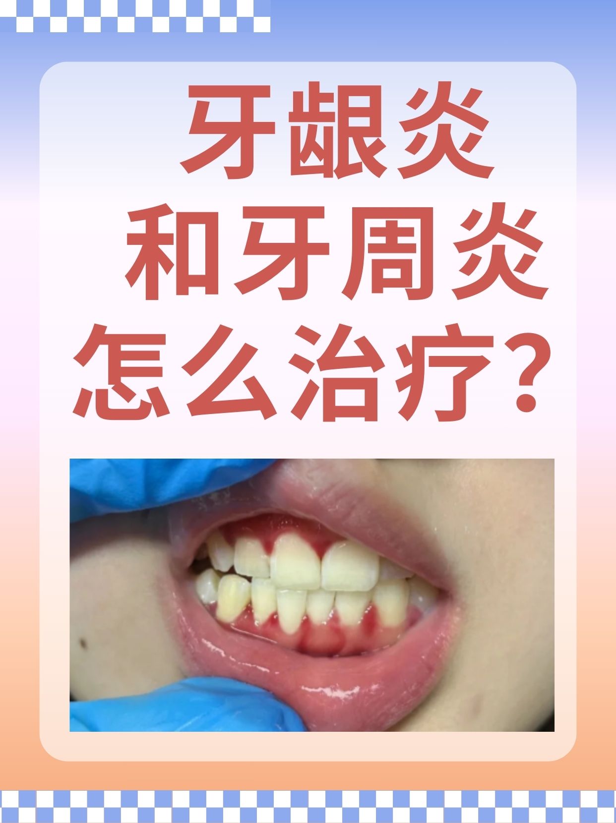 牙龈炎和牙周炎的区别是什么