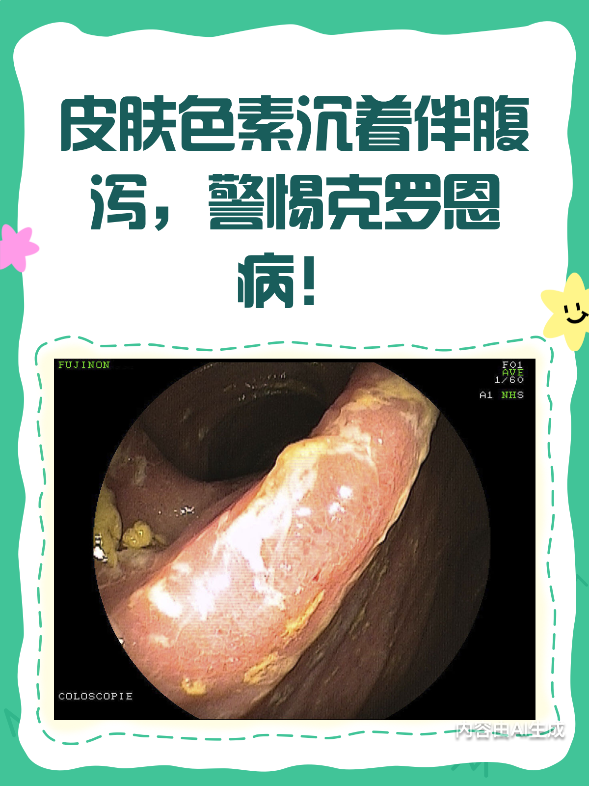 克罗恩病的临床表现