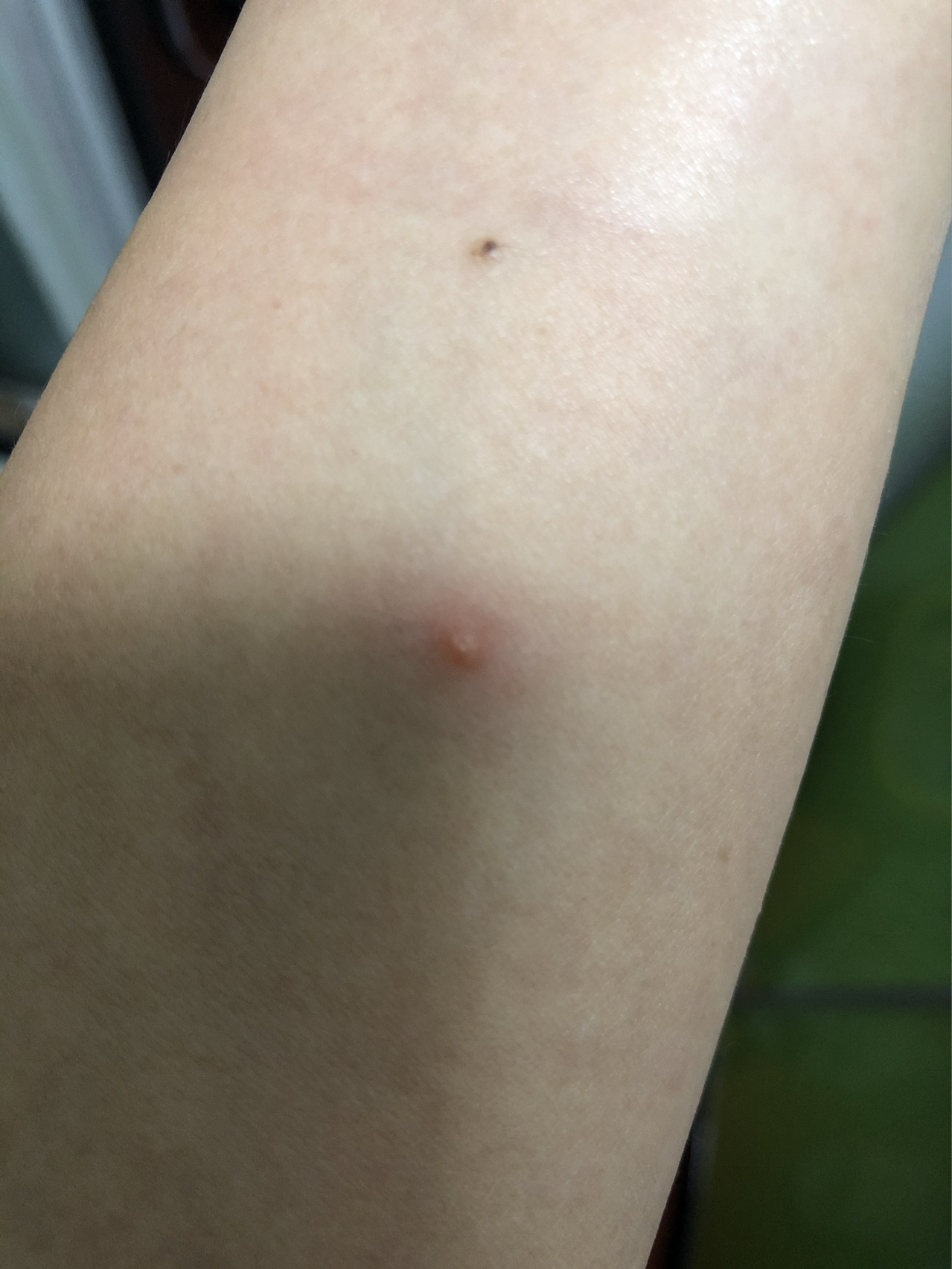 身上起小红包是什么原因