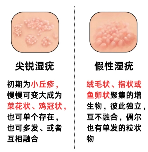 寻常疣,和尖锐湿疣的区别有哪些?请医生解说一下这个