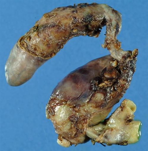 胆总管囊肿的症状