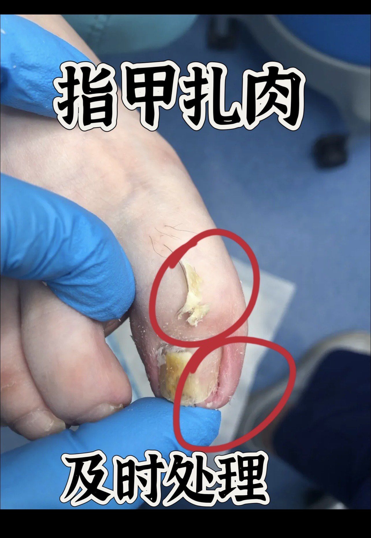 指甲长在肉里怎么办