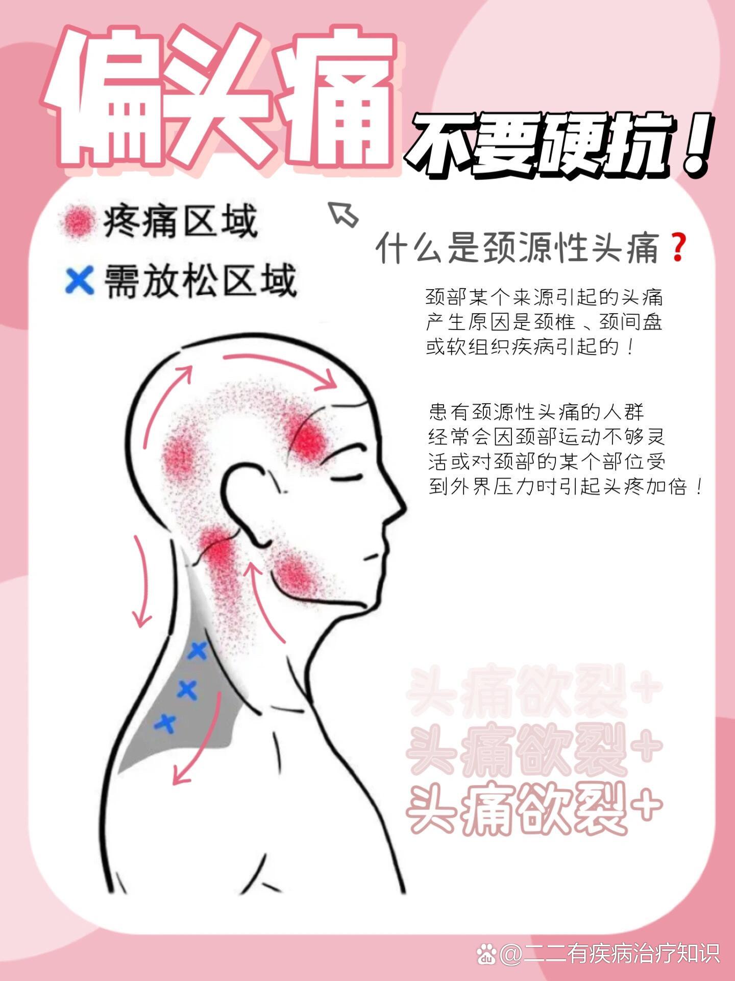 神经性头痛怎么治疗?