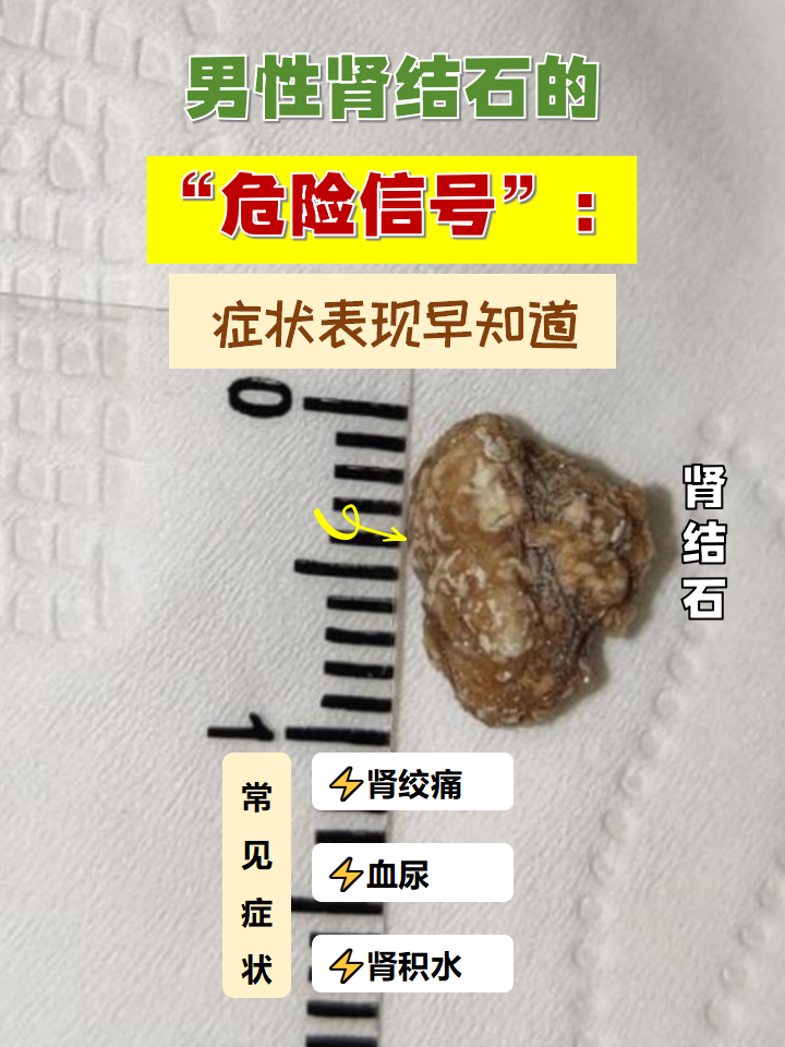 肾绞痛的病因有哪些