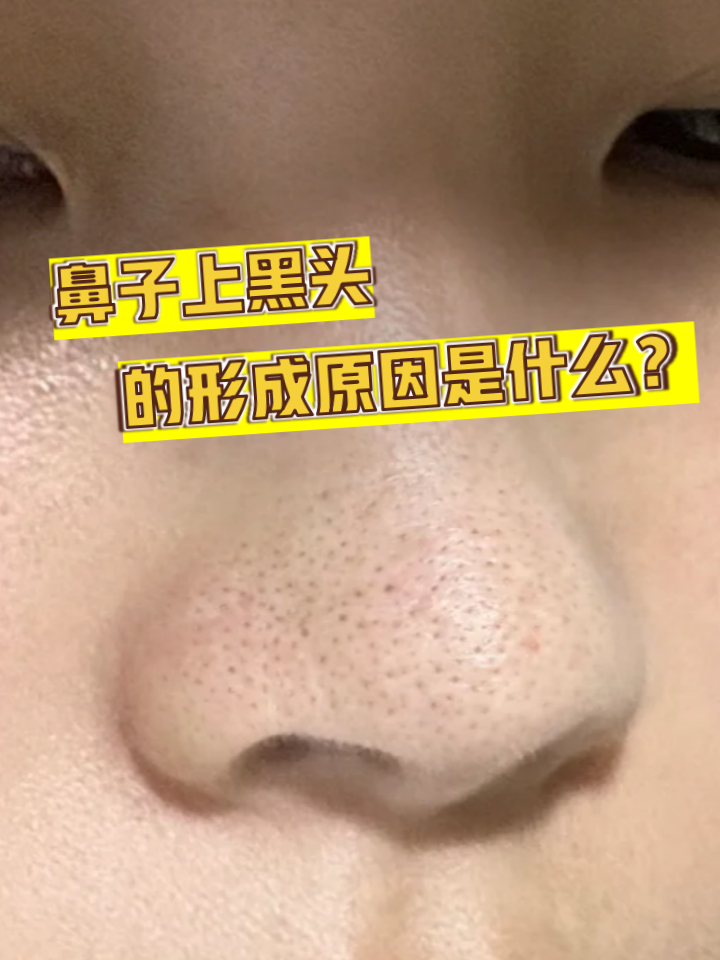 鼻子上的黑头是什么原因引起的