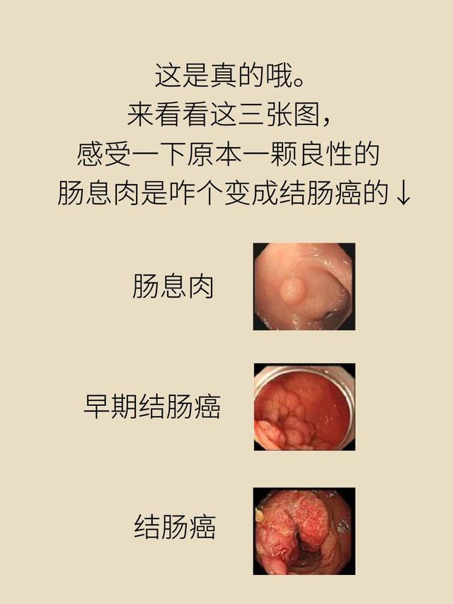 肠道息肉病严重吗?
