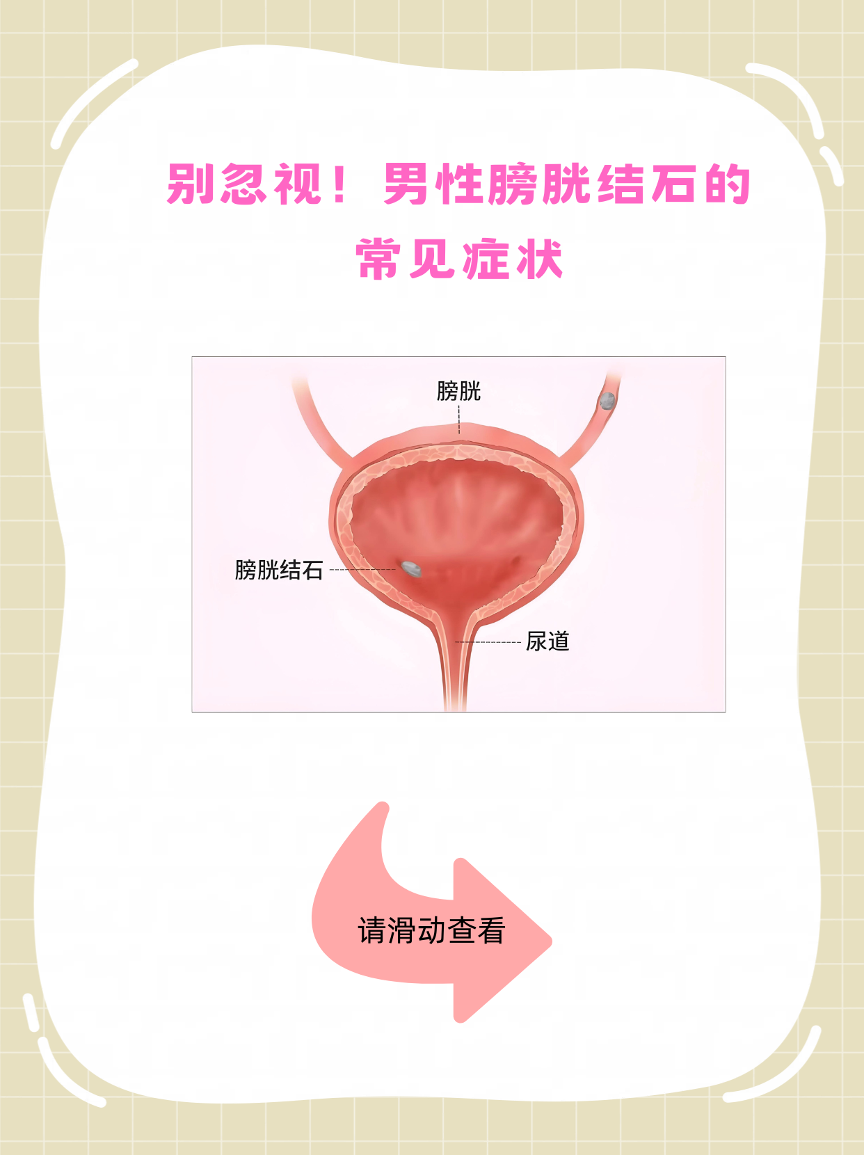 尿结石的症状有哪些