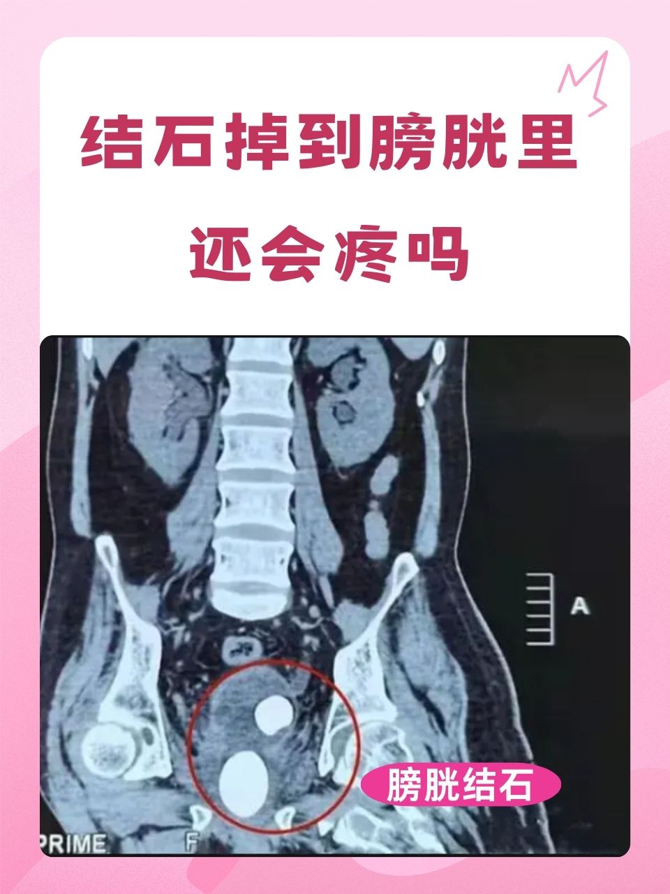 尿结石的症状有哪些