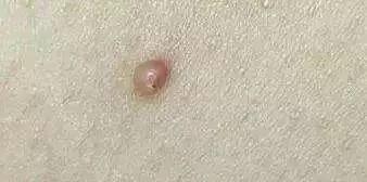 身上很多小肉粒,不痛不痒