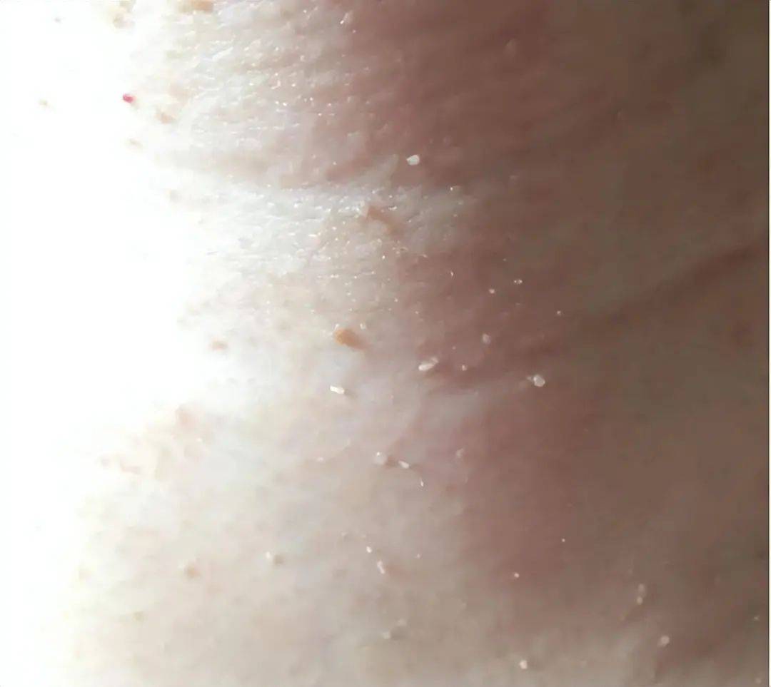 身上很多小肉粒,不痛不痒