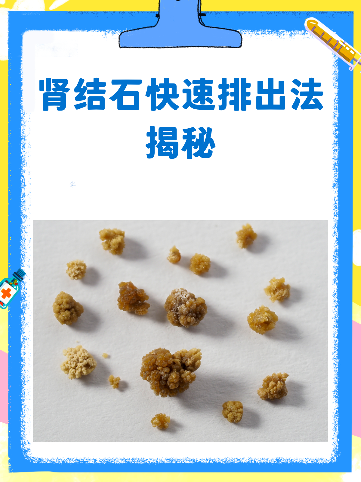 肾结晶是怎么回事