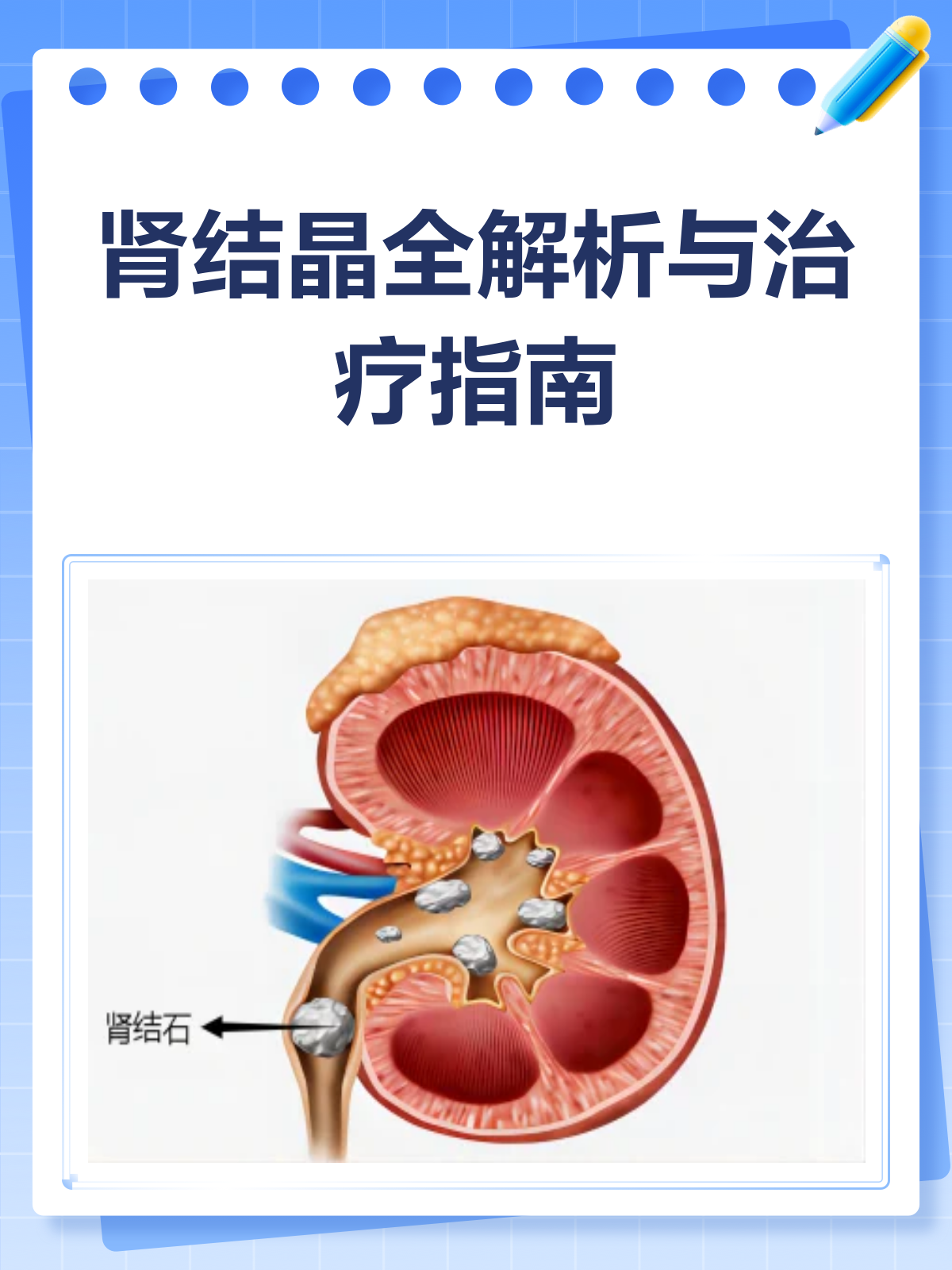 肾结晶是怎么回事