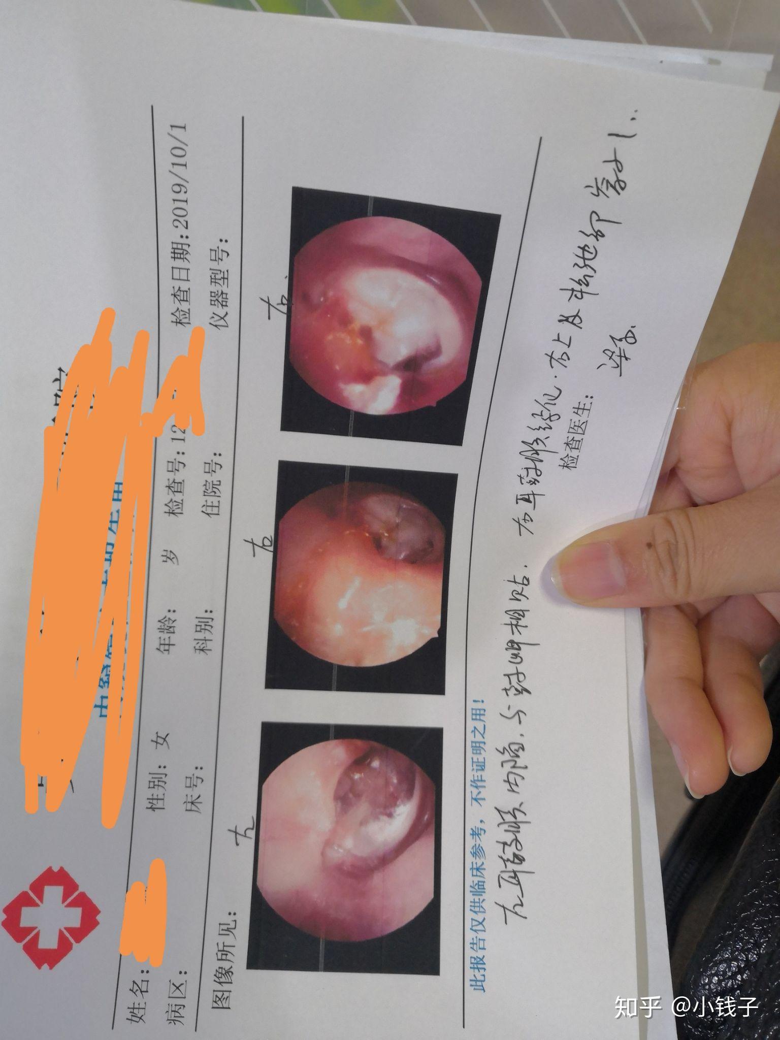 鼓膜内陷能自己恢复吗