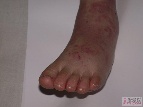 川崎病的症状有哪些?