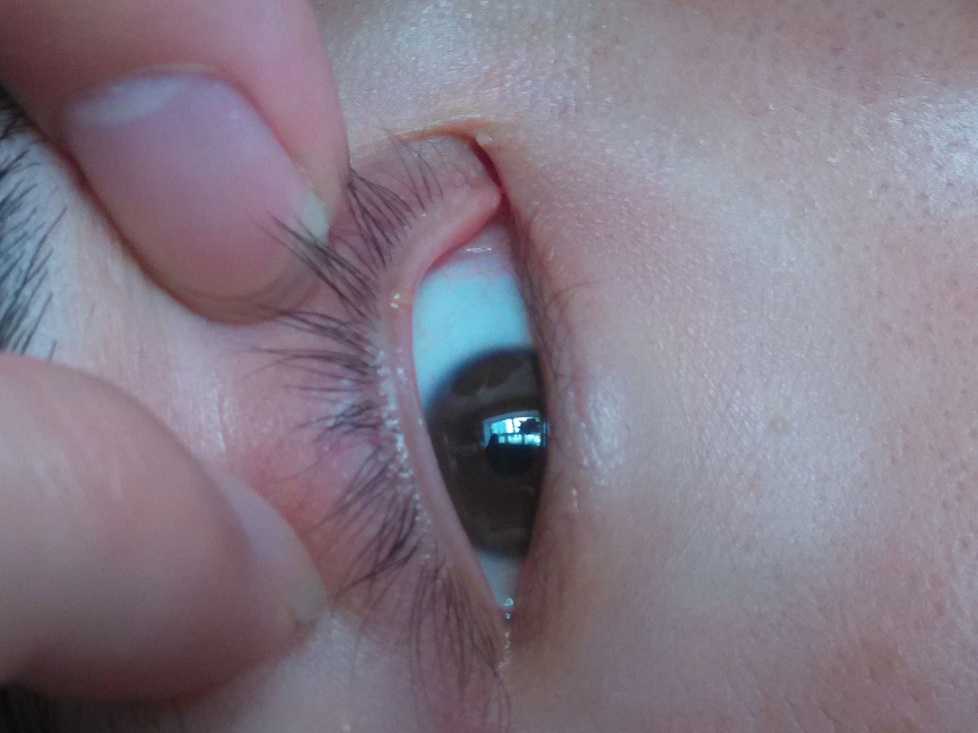 上眼皮里面起了个疙瘩