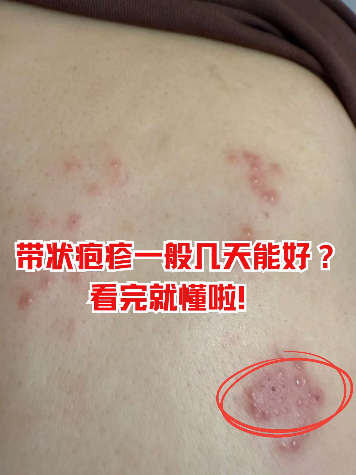 带状疱疹可以吃鸡蛋吗?